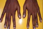 SICKLE CELL DISEASE PHOTO-3